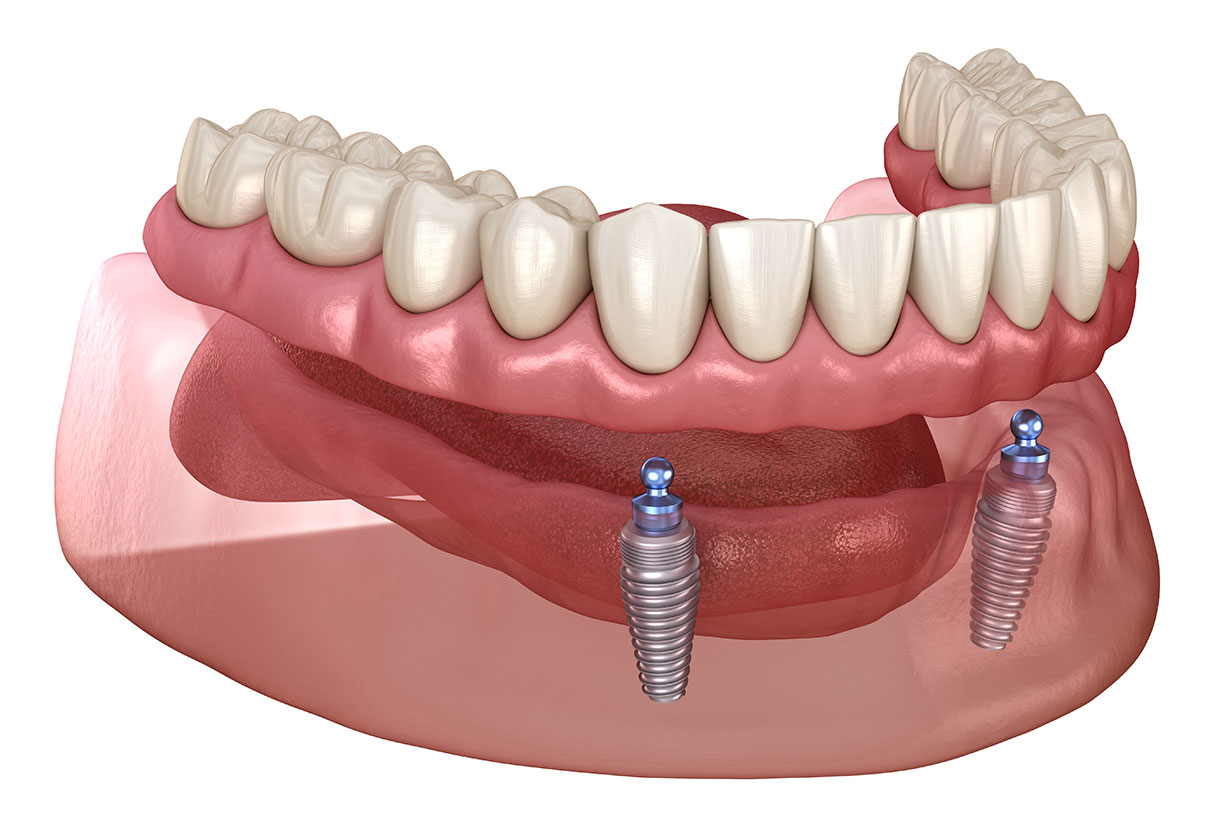 Implant Retained OverDenture