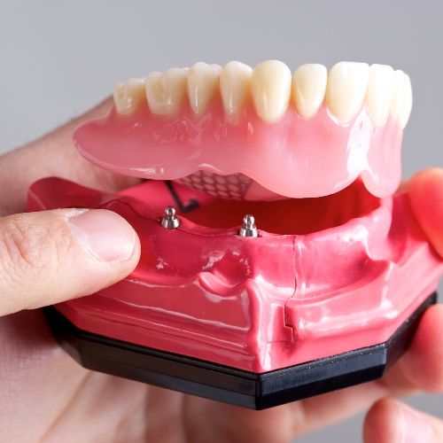 Complete & Partial Denture